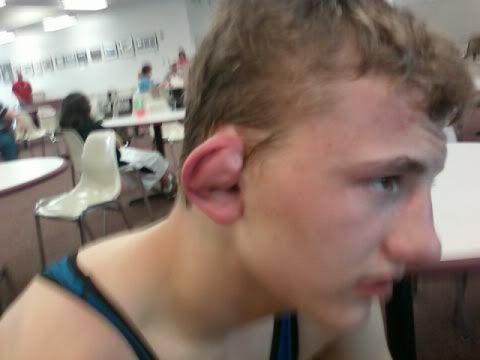 wrestler cauliflower ear