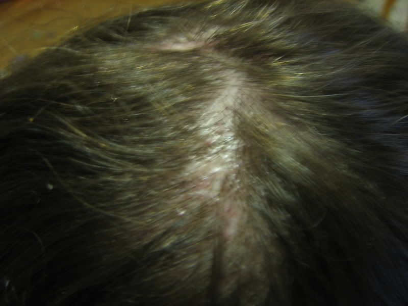 What are some causes of burning scalp with hair loss?