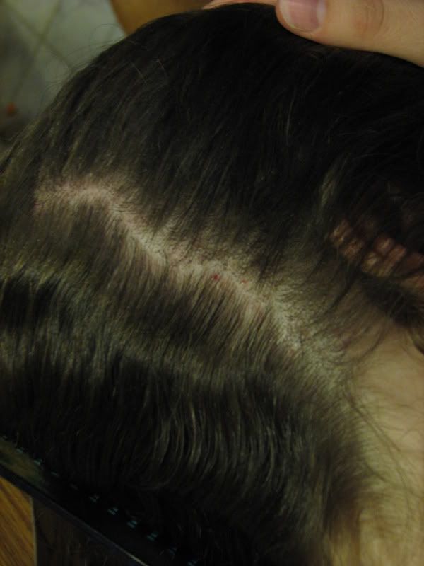 What are some causes of burning scalp with hair loss?