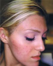 acne3.jpg